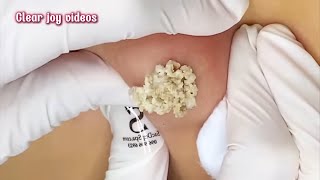 Big Cystic Acne Blackheads ExtractionBlackheads amp Milia Whiteheads Removal Pimple Popping [upl. by Nwahsit]