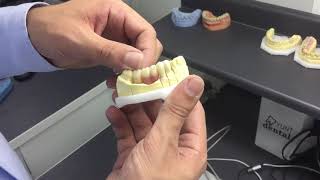 Prothèse fixe transvissée sur implant [upl. by Doherty]