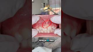 Você já ouviu falar na frenectomia e o enxerto gengival 🤔 dentes dentista [upl. by Ronoh]