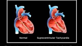 Supraventricular tachycardia [upl. by Gower572]