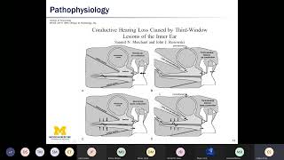 Superior Semicircular Canal Dehiscence  Dr Emily Stucken MD  University of Michigan [upl. by Nailimixam259]