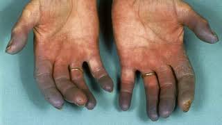 Difference Between Raynaud’s Disease and Buerger’s Disease [upl. by Cimah244]