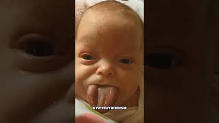 Macroglossia amp Tongue Habits Why Children Extend Their Tongues ChildDevelopment MacroglossiaFacts [upl. by Slotnick]