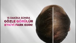 Saç Dökülmesini Önlemek ve Daha Gür Saçlar için İlk Uygulamada Etkili Bioxcin Şampuan ve Serum [upl. by Neille]