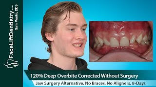 Deep Overbite Slanted Jaw Treatment No Surgery No Braces 8Days [upl. by Basile]