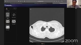 A structured approach common cases and pitfalls to CT Thorax [upl. by Yattirb]