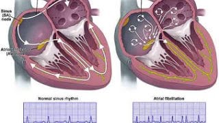 Atrial Fibrillation [upl. by Tnecillim]