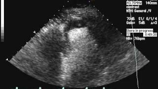 Apical Thrombus [upl. by Atiloj]