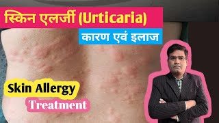 Skin Allergy Urticaria Cause And Treatment in Hindi  पित्ती का इलाज [upl. by Einohpets]