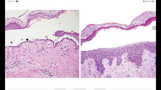 HISTOLOGÍA  PÉNFIGO FOLIÁCEO VS PENFIGOIDE AMPOLLOSO O VULGAR  EXPLICACIÓN FÁCIL [upl. by Kolodgie]