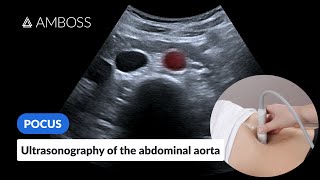 Point of Care Ultrasound of the Abdominal Aorta  AMBOSS Video [upl. by Salomon]