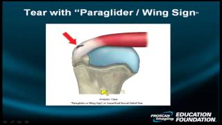 Shoulder Rotator Cuff Part III Focused on advanced rotator cuff descriptors cystic tears [upl. by Catlin920]