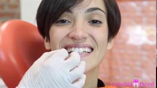 Applicazione Faccette Dentali  Torino [upl. by Chaworth]