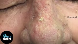 OVER 8 Minutes of SATISFYING Soft Pops Dr Pimple Popper [upl. by Akired]