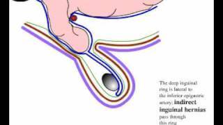 Direct and indirect inguinal hernia [upl. by Gaudet]