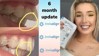 BRACES EXPLAINED Overbite vs Overjet [upl. by Ansilma]