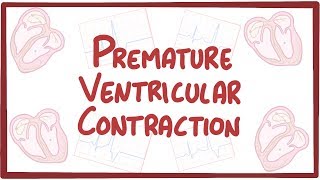 Premature Ventricular Contraction  causes symptoms diagnosis treatment pathology [upl. by Hairom]