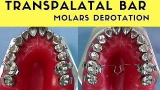 MOLARS DEROTATION [upl. by Kcirreg]