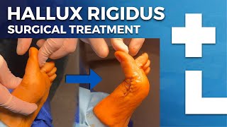 Hallux rigidus surgery  cheilectomy Moberg osteotomy  Dworska hospital® [upl. by Anol]