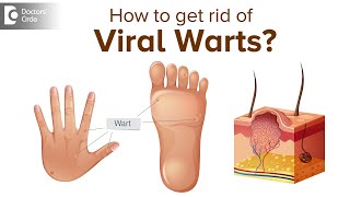 What are Viral Warts and what do we need to know about it  Dr Divya SharmaDoctors Circle [upl. by Esya]