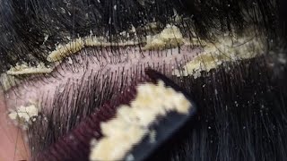 Dandruff scratching removal on head using black combing138 [upl. by Aan]