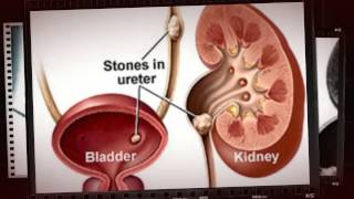 renal calculi symptoms and causes [upl. by Bobbye]