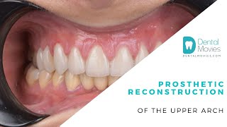 Prosthetic reconstruction of the upper arch [upl. by Obe]