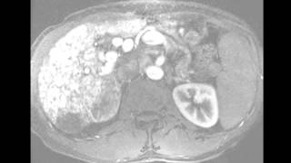 Hereditary Hemorrhagic Telangiectasia of the Liver [upl. by Henghold685]