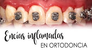 ENCÍAS INFLAMADAS CON ORTODONCIA  CAUSAS Y TRATAMIENTO [upl. by Yorker50]