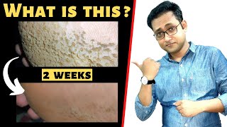 Skin infection treatment  Pitted keratolysis  Bacterial infection of skin [upl. by Ritchie65]