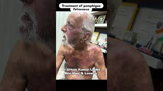 Pemphigus foliaceous treatment skin peel disease [upl. by Novyaj]