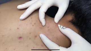 ACNE TREATMENT WITH VU QUYNH MI  Acne on Back amp Chest 2023p1 [upl. by Dlanod309]