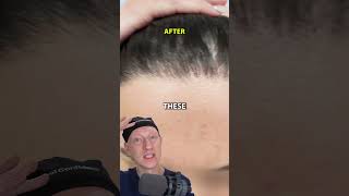 How I Got An INCREDIBLE Hairline Lowering Result [upl. by Ynohtnad]