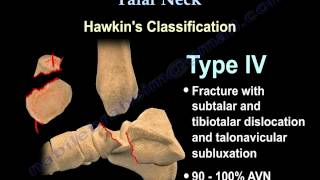 Talus fracture Hawkins Classificaiton  Everything You Need To Know  Dr Nabil Ebraheim [upl. by Haggi]