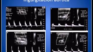 Analisis Onda Espectral Arterias Carótidas y Vertebrales [upl. by James288]