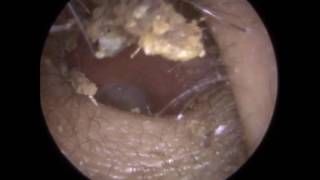 206 Ear Wax CRUMBLE Removed using Ear Hook and Jobson Horne  Mr Neel Raithatha THC [upl. by Noremmac]