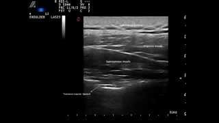 Ultrasound guided suprascapular nerve block by Murat Karkucak MD [upl. by Luna]