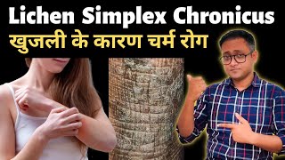 Lichen simplex chronicus  A very common skin problem  Hindi  Dr Supratim Saha [upl. by Hesketh]