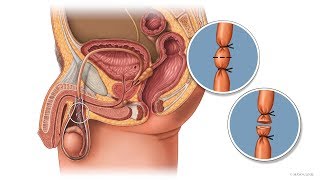 Mayo Clinic Minute Why a vasectomy is a great option for birth control [upl. by Salta]