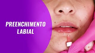 Aula de Preenchimento Labial [upl. by Brockie]