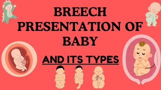 Breech Presentation of Baby Understanding Types Risks and Delivery Options Novice Medic [upl. by Emyam]