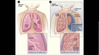 Lymphatic system diseases [upl. by Enowtna]