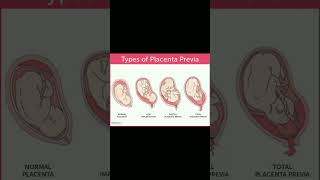 Types of placenta previa implantation  bleeding 🩸knowledge medical shortvideo share [upl. by Othello]