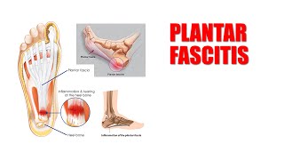 Plantar Fasciitis Self Treatment [upl. by Russi516]