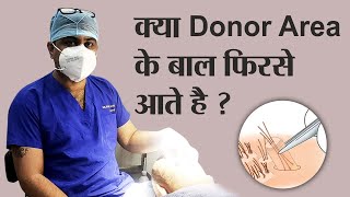 Donor Area After Hair Transplant  क्या Donor Area के बाल फिर से आते है  hairtransplant [upl. by Nanfa]