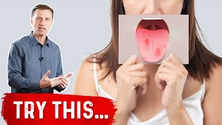 Burning Mouth Syndrome Demystified [upl. by Terrene]