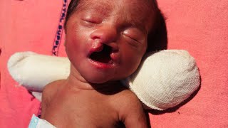 Showing Cleft Lip Cleft Palate on Livecreativityislife [upl. by Etnoj]