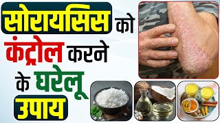 Psoriasis homeopathy in hindi  Home remedies to cure Psoriasis  Skin Disease Treatment [upl. by Enneyehc523]