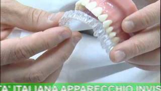 ODONTOIATRIA Invisalign  Apparecchio Invisibile [upl. by Eletnahs]