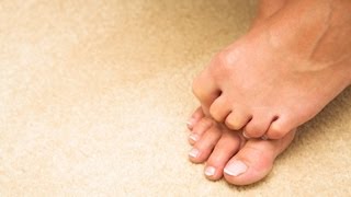 How to Prevent amp Treat Hammer Toes  Foot Care [upl. by Einiffit]